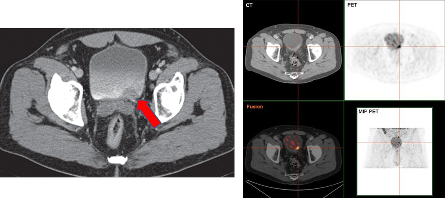 Şekil-5: Mesane tümörünün bilgisayarlı tomografi ve PET-CT görüntüsü