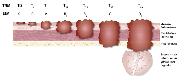 Bladder Cancer Staging