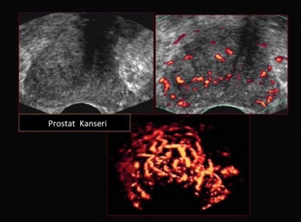 Ultrason, Mri Klavuzluğunda Prostat Biopsisi Nedir?
