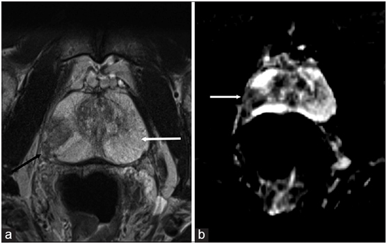 MRI ile prostat değerlendirilmesinde kullanılabilien “EndorectalCoil”