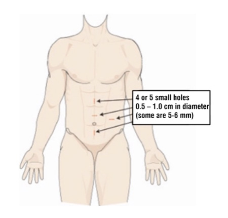 Image-2: Robotic Partial Nephrectomy – Locations of the small holes opened on anterior abdominal wall during robotic or laparoscopic kidney surgeries. Robotic technology, with the advantages it brought, has an important place in partial (nephron sparing) surgery.