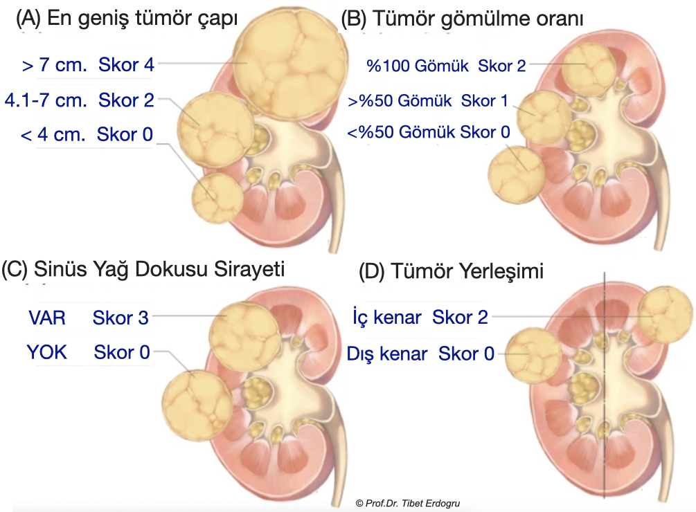 Şekil-4: Böbrekteki tümörün çapı, böbreğe gömüklük derecesine göre skorlamalarla risk durumunun skorlaması yapılır.