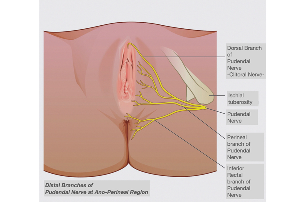 Robotic Surgery in Pudendal Neurolysis (as Robotic Pudendal Nerve Decompression Surgery)