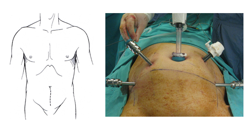 Prostat Cancer