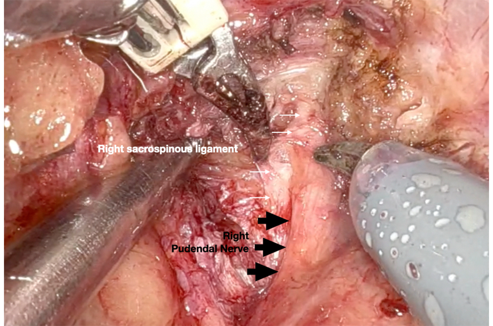 Robotic Surgery in Pudendal Neurolysis (as Robotic Pudendal Nerve Decompression Surgery)