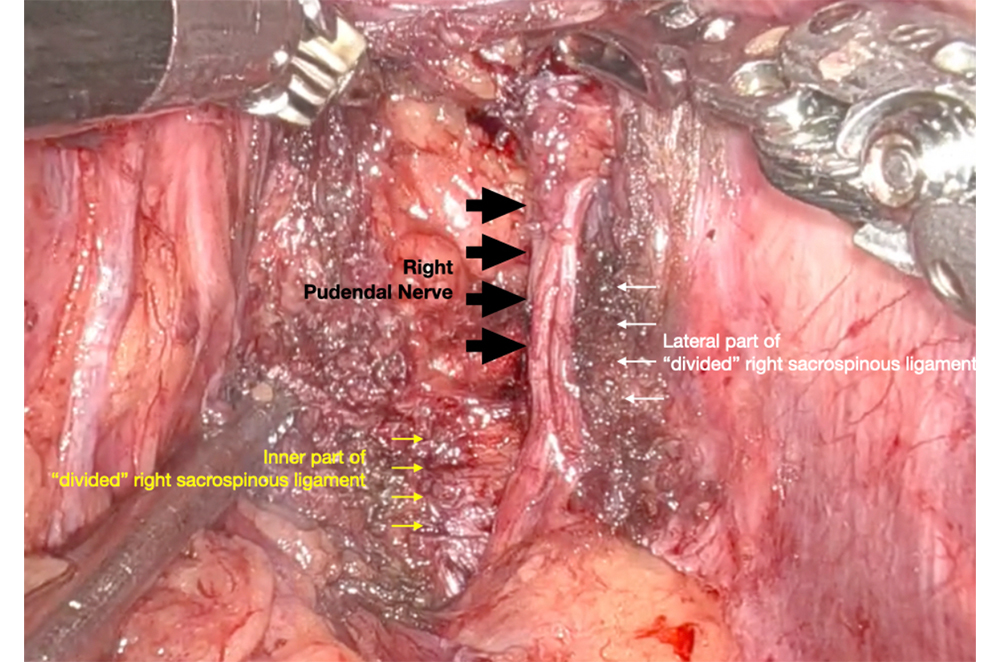Robotic Surgery in Pudendal Neurolysis (as Robotic Pudendal Nerve Decompression Surgery)