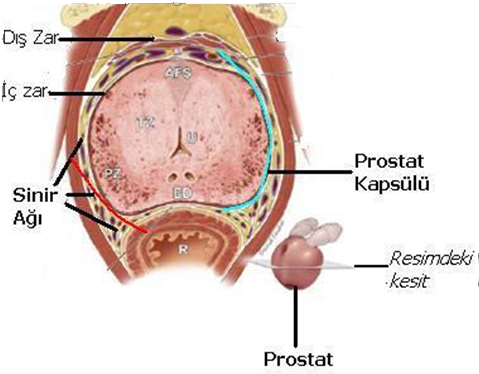Resim-5: Prostat kanseri ameliyatında farklı şekilde korunan penise giden sinir ağının anatomik görüntüsü