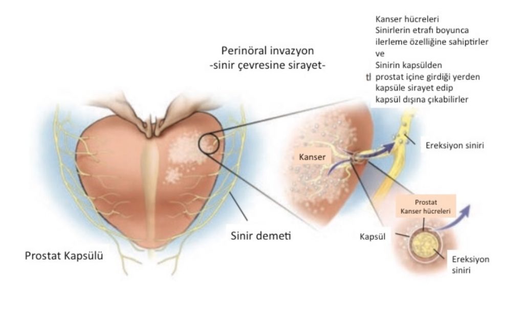 Resim-2: Perinöral boşluğa sirayet eden kanser hücreleri, bu boşluğun yarattığı tünel boyunca ilerleyerek prostat bezi dışına çıkabilir.