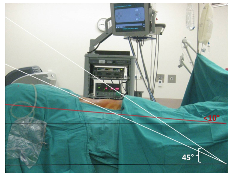 Resim-7: “Ekstra-Periton” Robotik Cerrahi uyguladığımız hastamızdaki yatış pozisyonu görülmektedir. Siyah çizgi yere paralel olan çizgiyi gösterirken, Kırmızı çizgi hastanın yer ile yaptığı açıyı göstermektedir. Genellikle uygulanan “Trans-Periton” teknikte hasta yatış pozisyonu Beyaz Çizgi ile ifade edilmiştir. Buradaki hastanın yatış açısı baş aşağıya 45°dir.