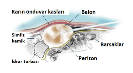 Resim-6a: Periton zarı ile (sarı renkli çizgi), barsaklarla temas etmeden, karın ön duvar kasları arasında balon ile ameliyatı yapmak için boşluk açılır.
