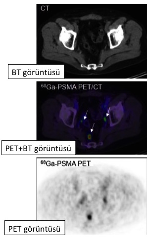 Şekil-1: Rektuma yerleştirilen ultrasonografi alıcısı ile incelenerek biopsi alınır