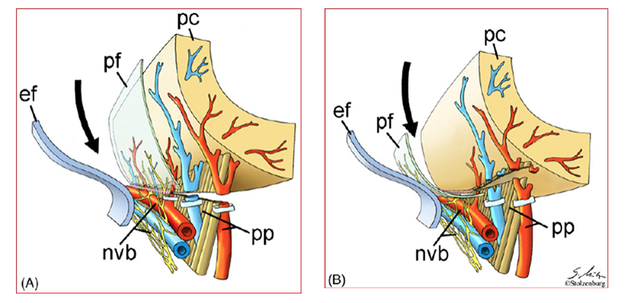 Resim-11a ve 11b: İnterfascial ve İntrafascial sinir koruma tekniği arasındaki şematik farklılık