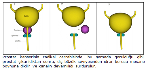 Resim-2: Protat kanserinin radikal cerrahisinde, bu şemada görüldüğü gibi, prostat çıkarıldıktan sonra, dış büzük seviyesinden idrar borusu mesane boynuna dikilir ve kanalın devamlılığı sürdürülür.