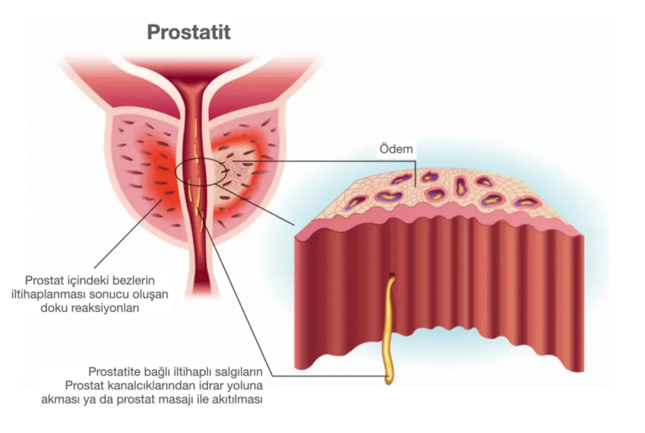 PSA (Prostat Spesifik Antijen) Nedir?