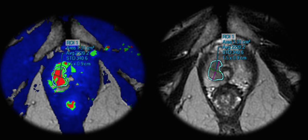 Ultrason, Mri Klavuzluğunda Prostat Biopsisi Nedir?