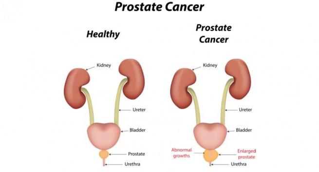 Prostat Kanseri tedavisi ve ilaç kullanımı