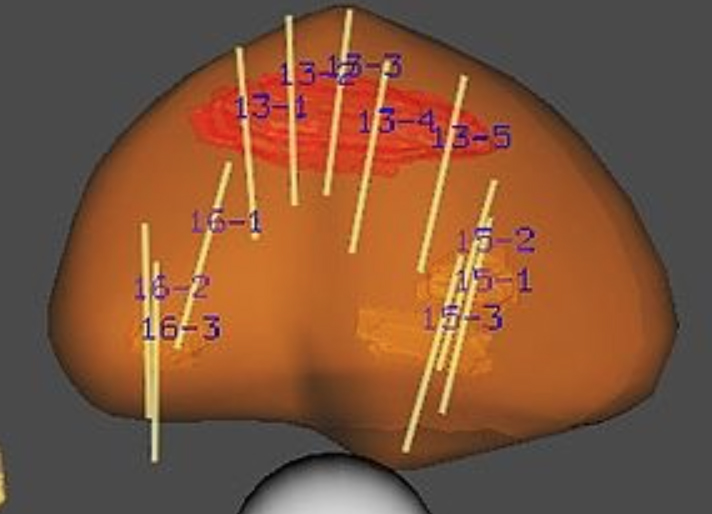 Ultrason, Mri Klavuzluğunda Prostat Biopsisi Nedir?