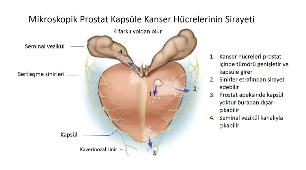 Prostat Kanserinde kanserin kapsül dışına yayılma yolları nelerdir?