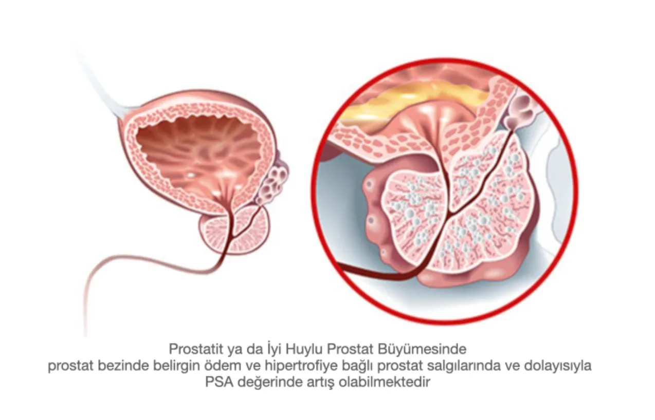 PSA (Prostat Spesifik Antijen) Nedir?