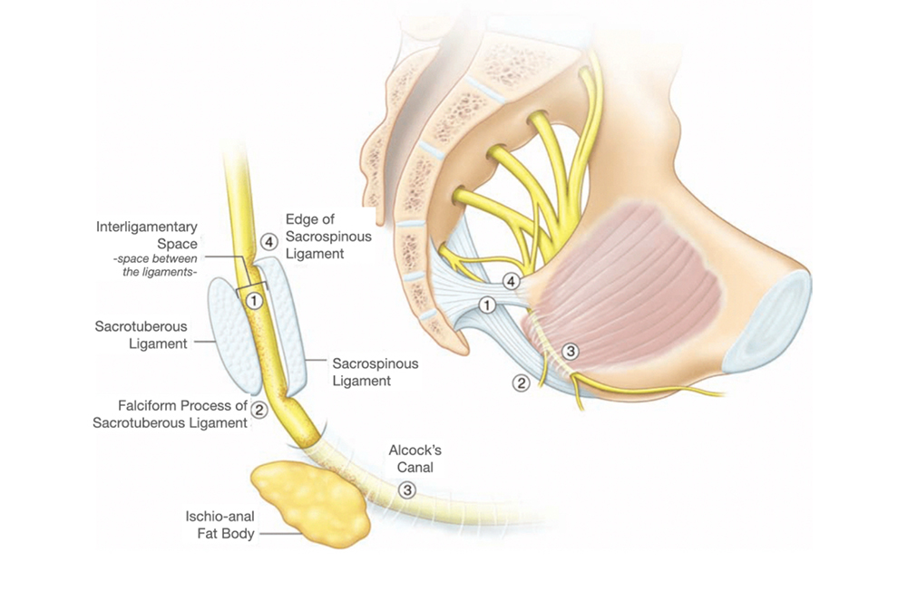 Robotic Surgery in Pudendal Neurolysis (as Robotic Pudendal Nerve Decompression Surgery)