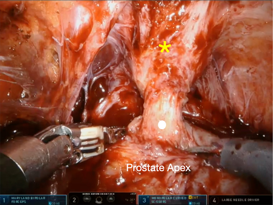 Robotic Prostate Cancer Surgery
