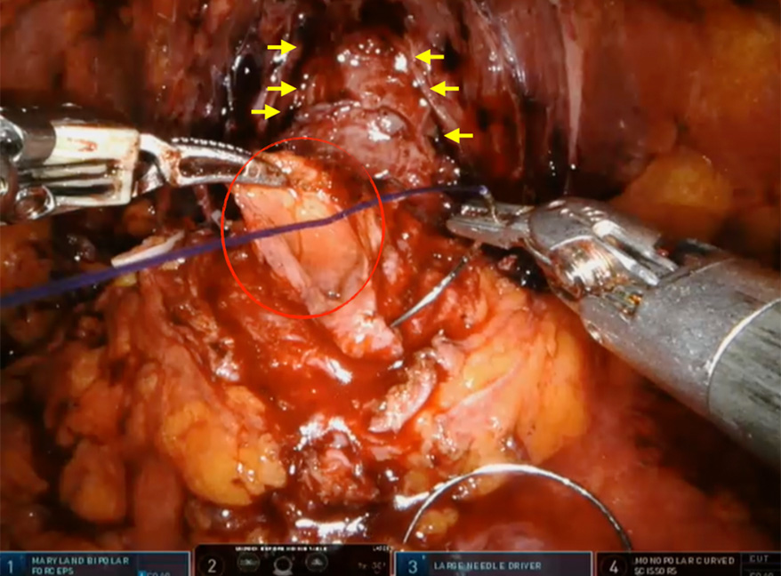 Robotic Prostate Cancer Surgery
