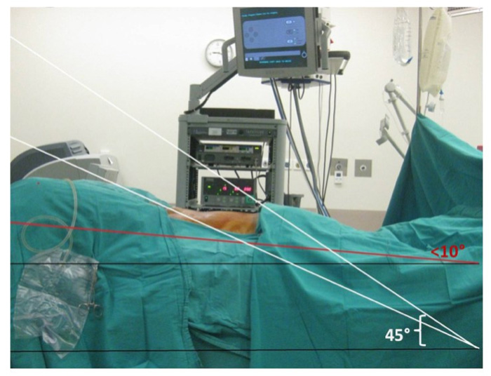 Robotic Prostate Cancer Surgery
