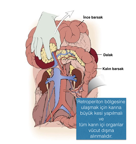 Retroperitoneal Lenf Nod Disseksiyonu (RPLND) ne demektir?