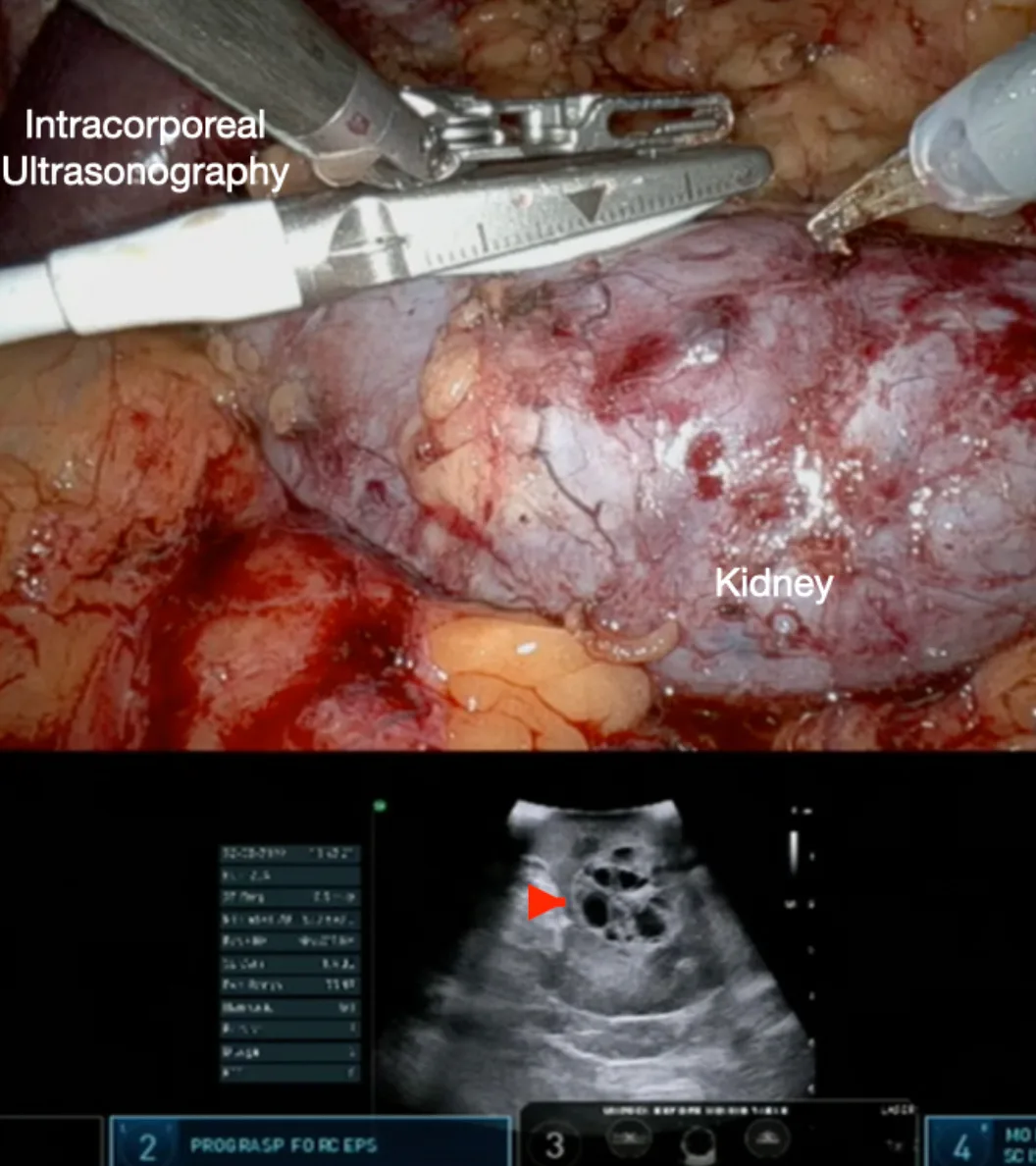Robot Assisted Partial Nephrectomy