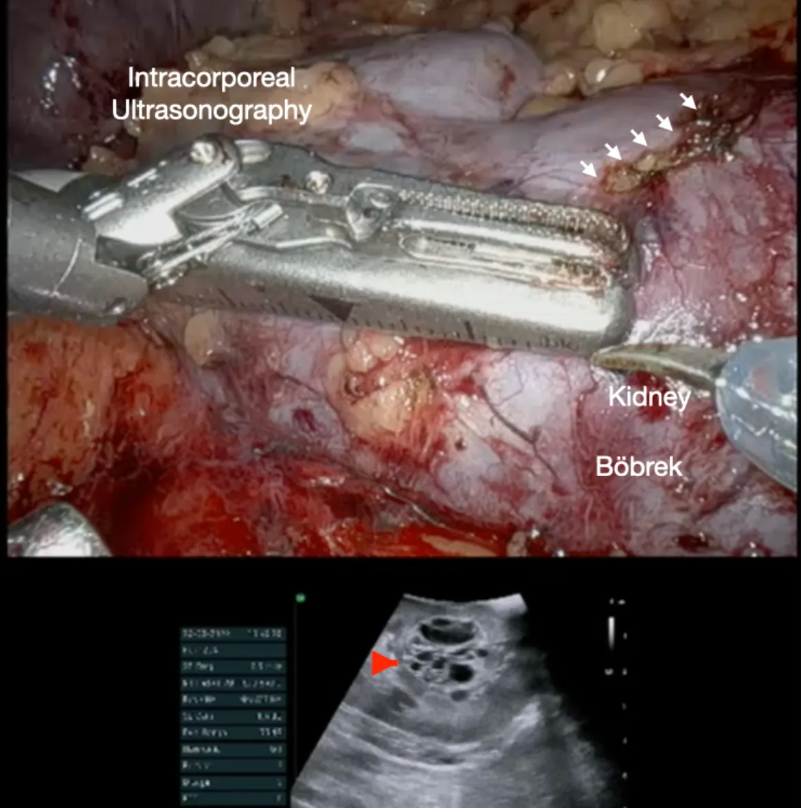 Robot Assisted Partial Nephrectomy