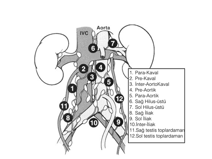 Retroperitoneal Lenf Nod Disseksiyonu (RPLND) ne demektir?