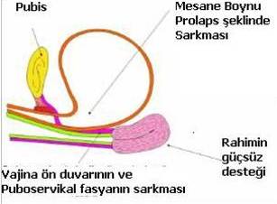 Mesane Sarkması