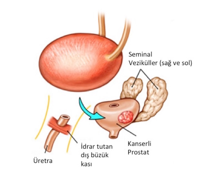 Resim-1). Prostat aradan çıkartıldıktan sonra, idrar kesesi ağzı ile idrar borusu birbirine dikilir.