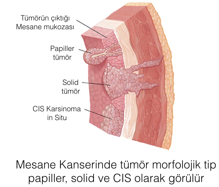 Mesane Kanseri Nasıl Anlaşılır?