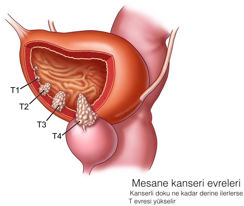 Mesane Kanseri Nasıl Anlaşılır?