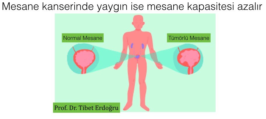 Mesane Kanseri Nasıl Anlaşılır?