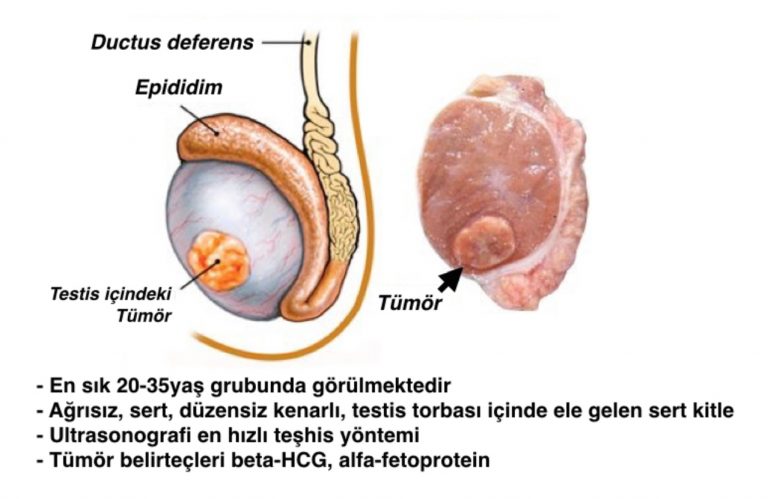 Testis Kanseri Gelişiminde Risk Faktörü ve Testis Kanseri’nde Ölüm Oranı Nedir ?