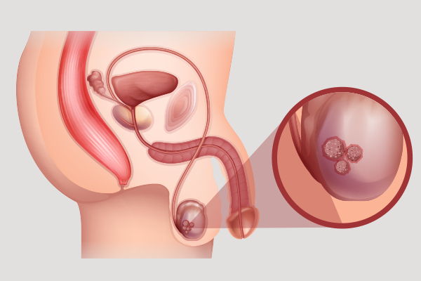Testis Kanserinde Evrelendirme