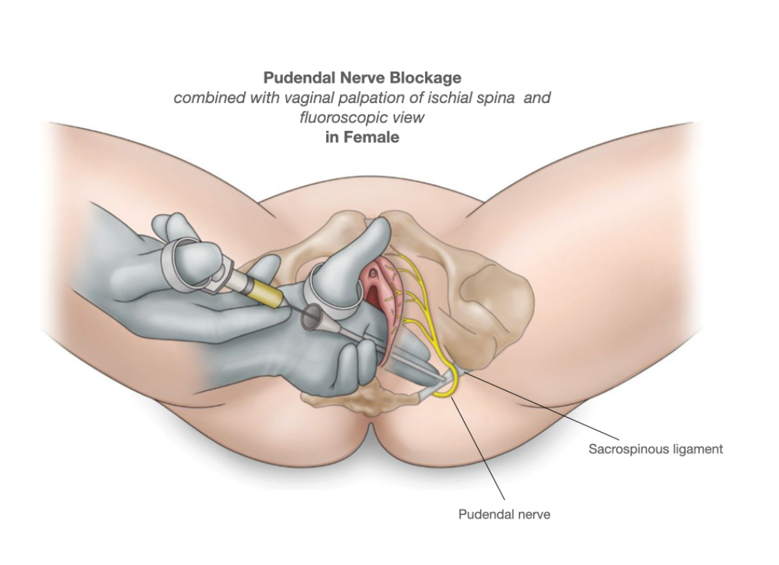Pudendal Nerve Entrapment Syndrome