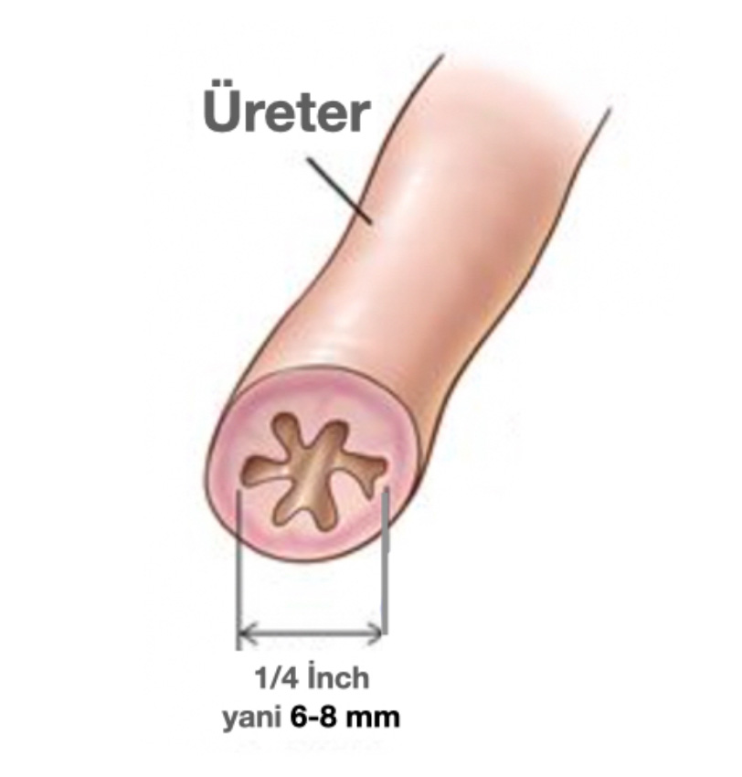 Üreter Darlığı (İdrar Kanalı Darlığı) Tedavisi Nedir?