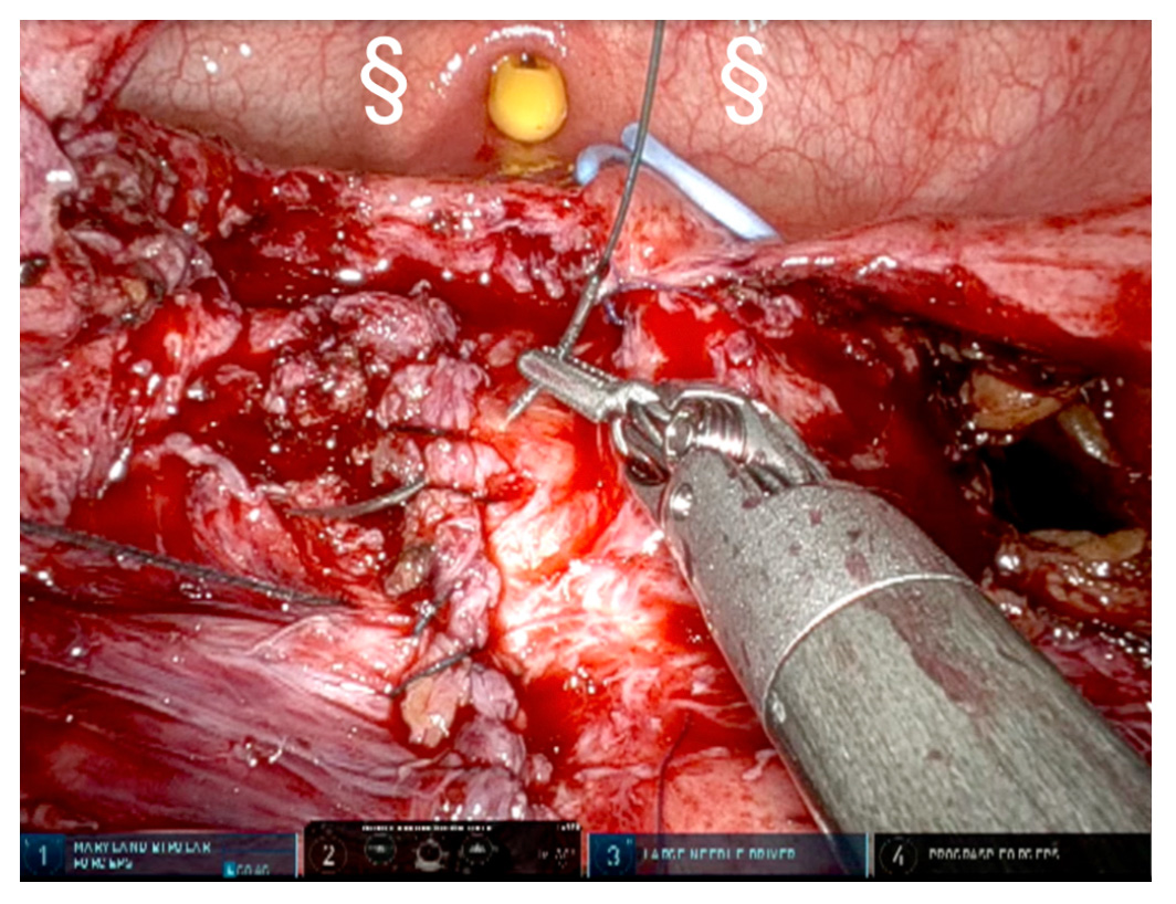Figure-7: Bilateral single J stents can be identified in the figure and mental flap placement and fixing over the anterior vaginal wall. # Omental flap