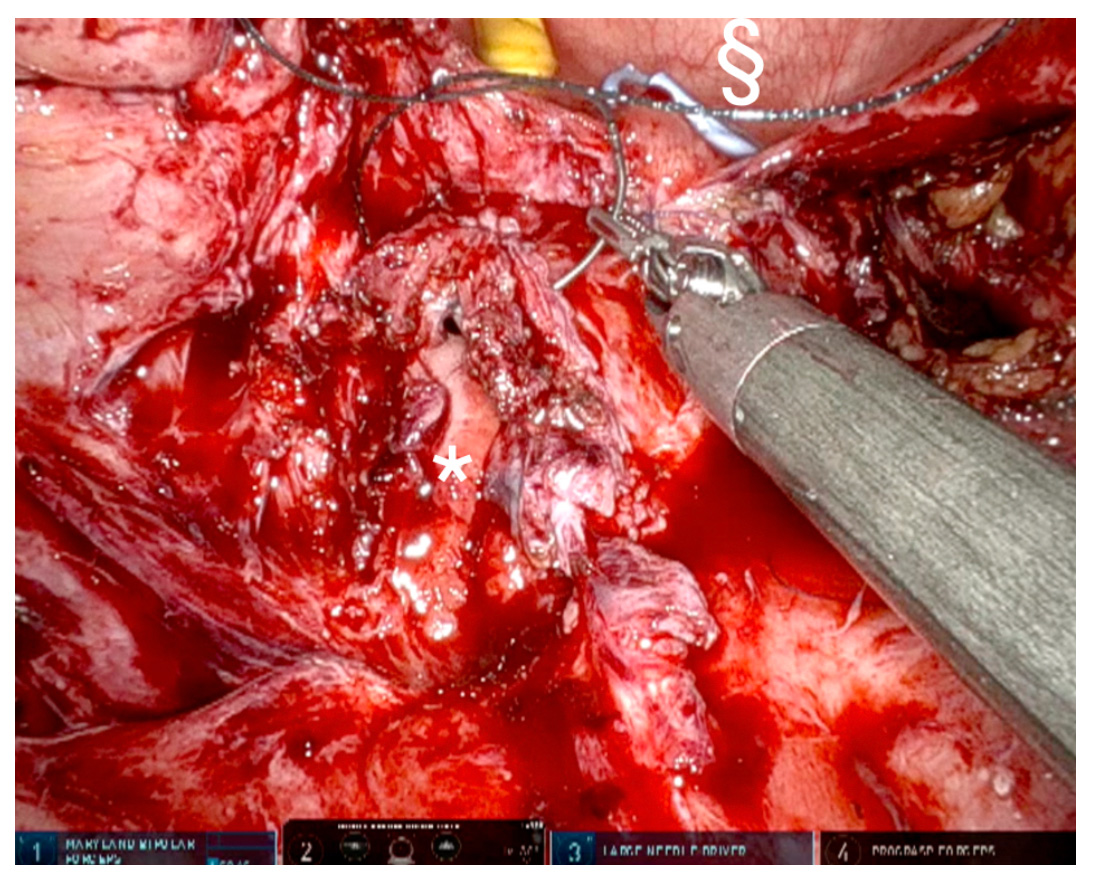 Figure-6a: Anterior vaginal wall is closed with continue V-lok sutures, its the first layer. * Vaginal inside, § Bladder inside