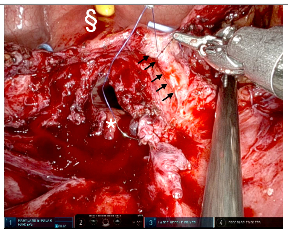 Figure-5: Right ureteral fistula side is repaired using 5-0 Vicryl (black arrows), §: Bivalved bladder and bladder inside in which bilateral JJ stents and Foley catheter can be observed.