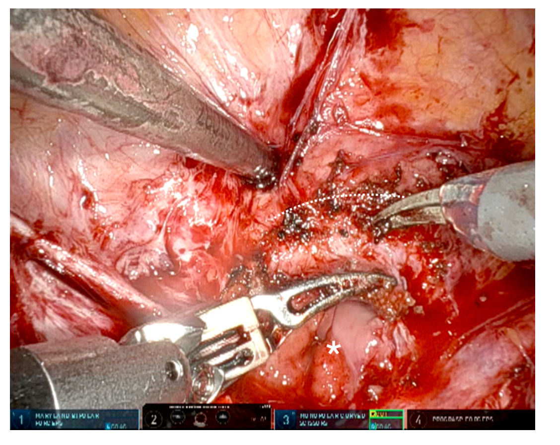 Figure-4: Severe scar tissue between anterior vaginal wall and bladder posterior