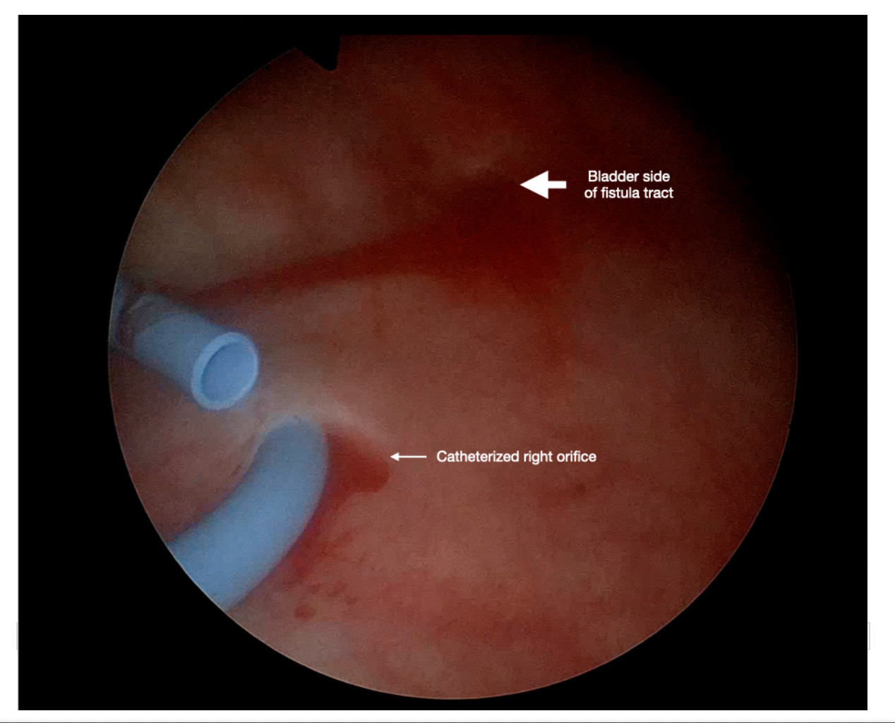 Figure-3: Cystoscopic view with catheterized right ureteral orifices and very close fistula tract