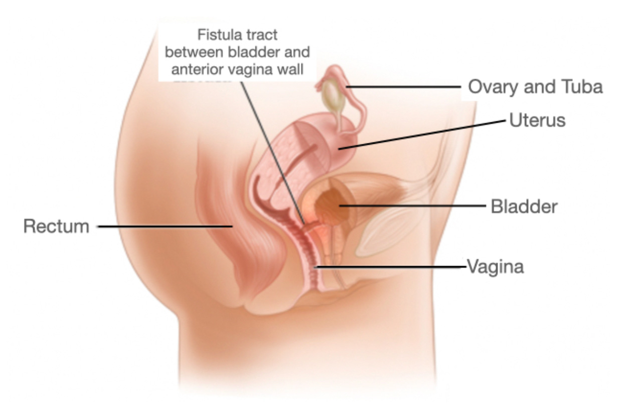Figure-2: Fistula is occurs between two hollow organs as in VVF between bladder and vagina