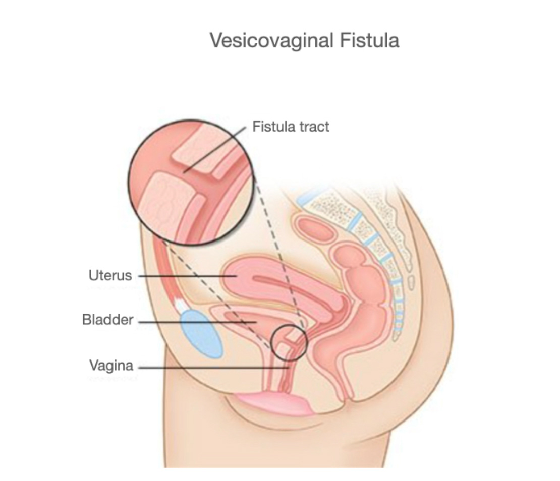 Figure-1: Vesicovaginal fistula between posterior bladder wall and anterior vaginal wall