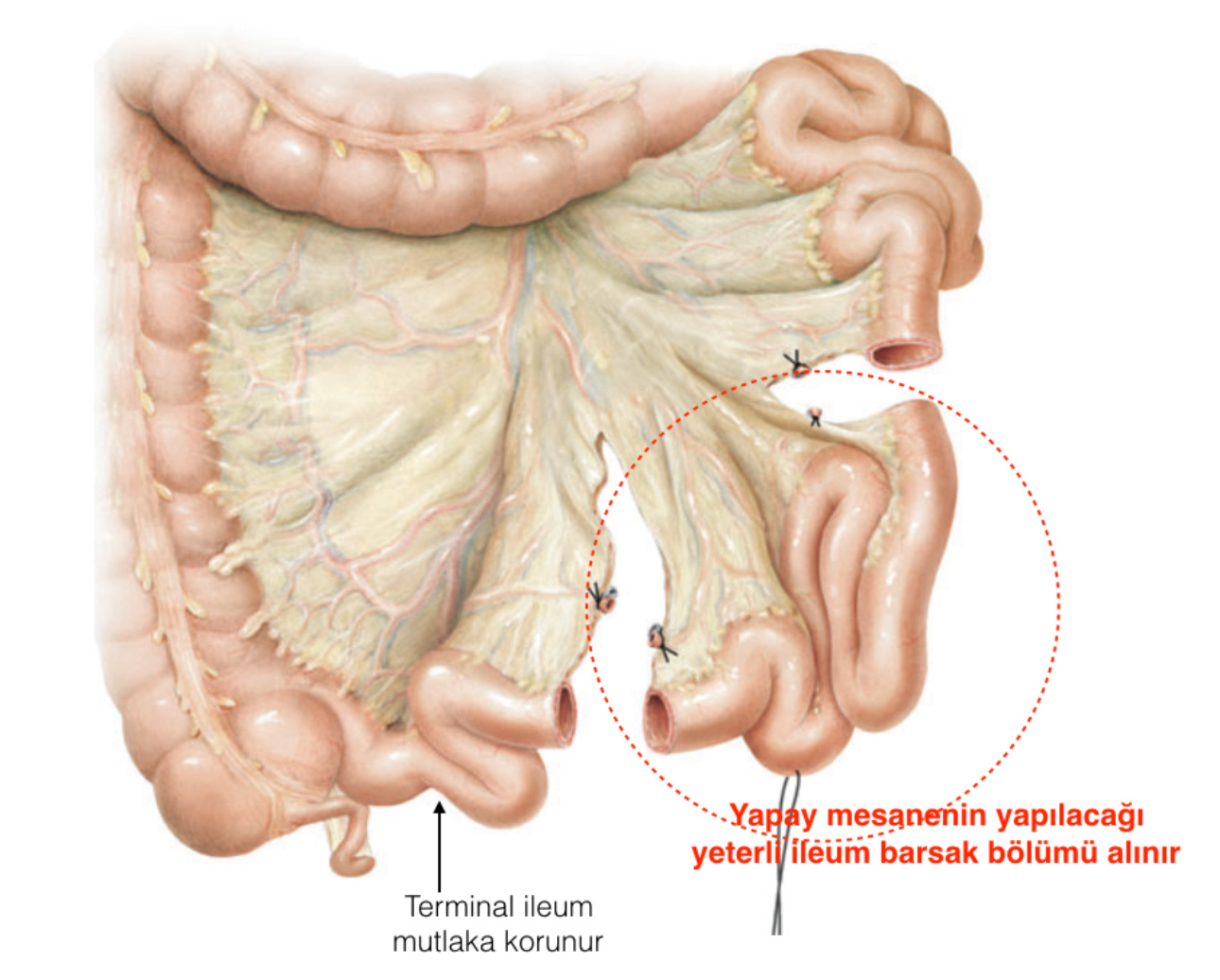 Yapay Mesane sonrasında görülebilecek metabolik bozukluk olabilir mi?
