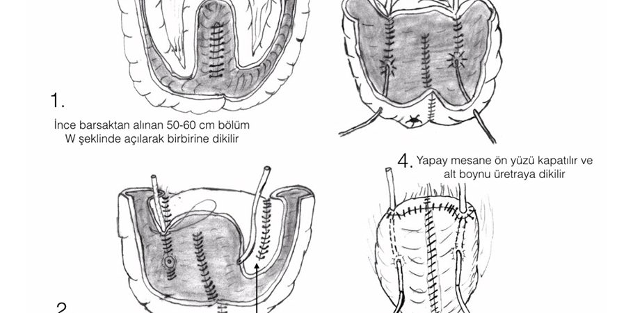 Yapay Mesane Nedir?