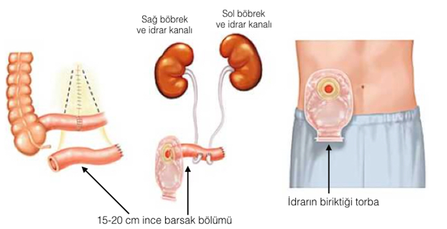 Yapay Mesane Nedir?
